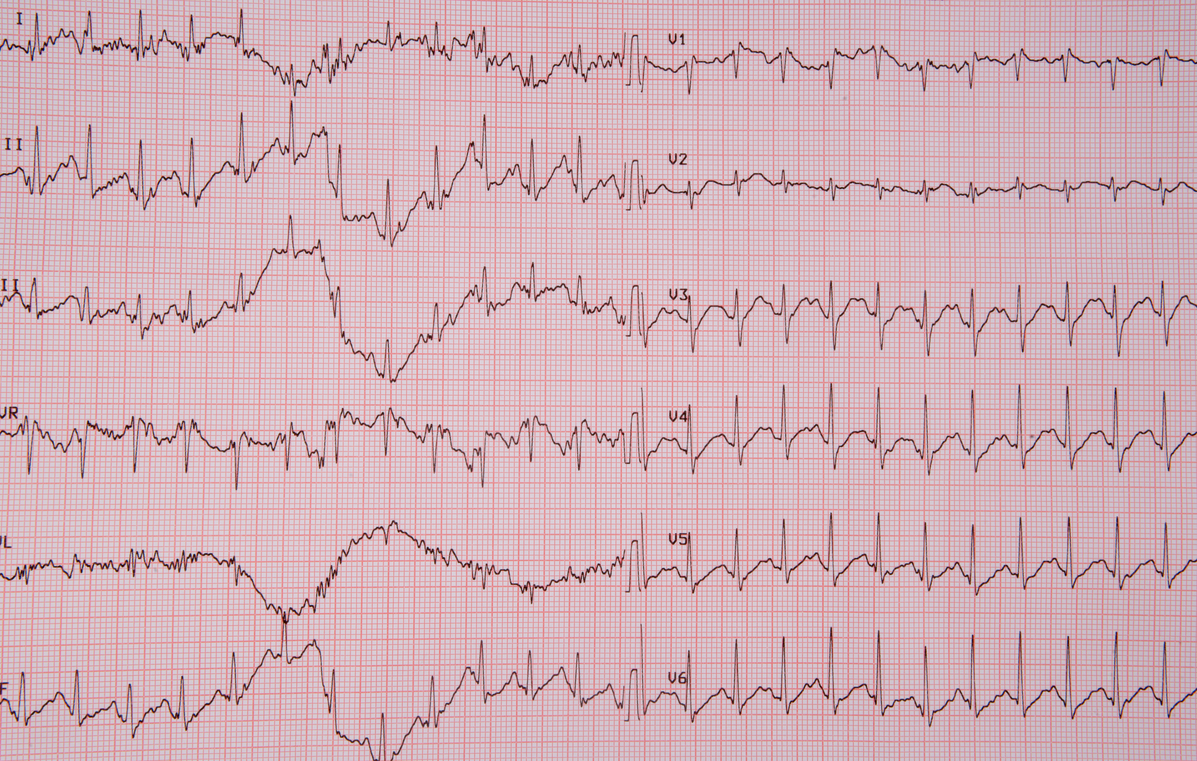 electrocardiogram